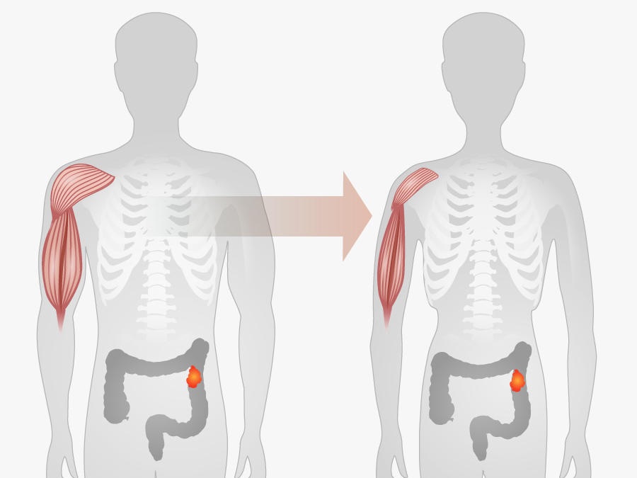 Đột ngột giảm cân - tiềm ẩn nhiều nguy cơ với sức khỏe