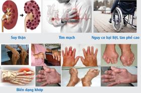 Kinh hãi với tứ chi u cục, biến dạng của người bị bệnh gout 10 năm